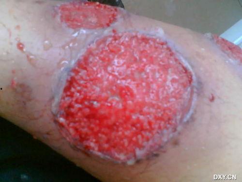 烂皮肤图片,图片背后的肌肤问题解析