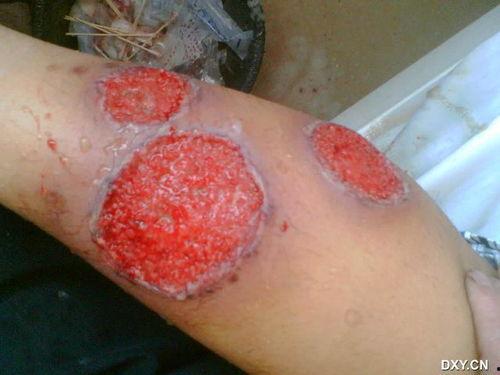 烂皮肤图片,图片背后的肌肤问题解析